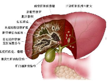 微创胆囊切除手术后便秘怎么办,胆囊切除术后便秘可以吃泻药吗