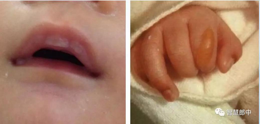 新生儿的几种生理现象图片,新生儿正常生理现象