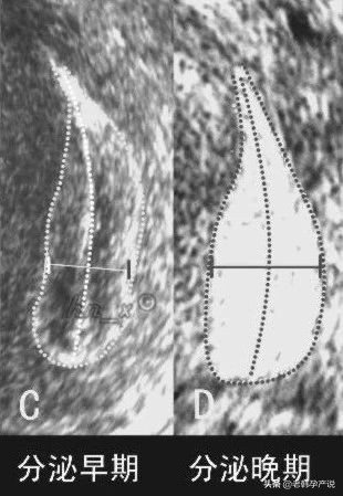 子宫内膜厚薄不均匀,子宫内膜薄该怎么办呢需要治疗吗