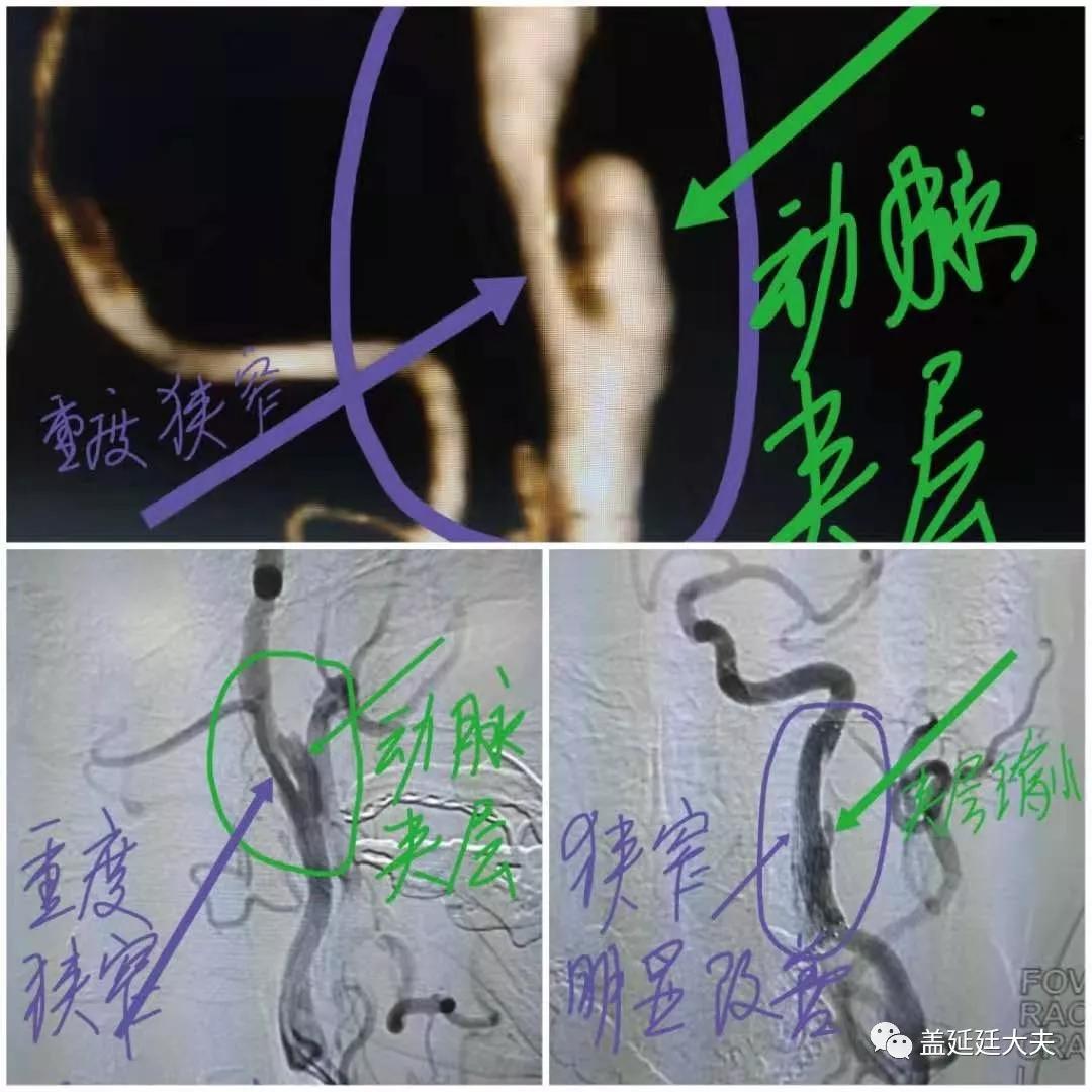 DR盖延廷||颈动脉夹层该如何治疗