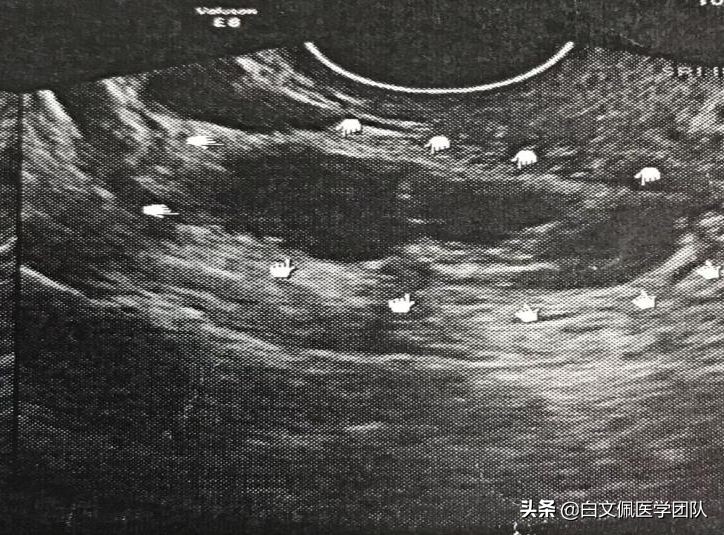 腹腔镜妇科解剖教学视频教程,白文佩医学团队