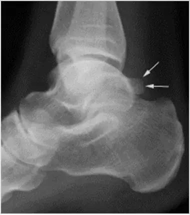 踝关节撞击症问诊,踝关节内侧撞击综合症位置图