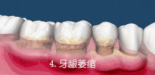 矫正牙齿的十大知识,牙齿矫正前你要了解这几件事