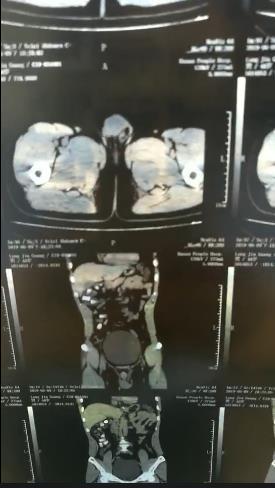 用命换钱的“骡子,是如何把大量*品毒**塞进自己体内的?