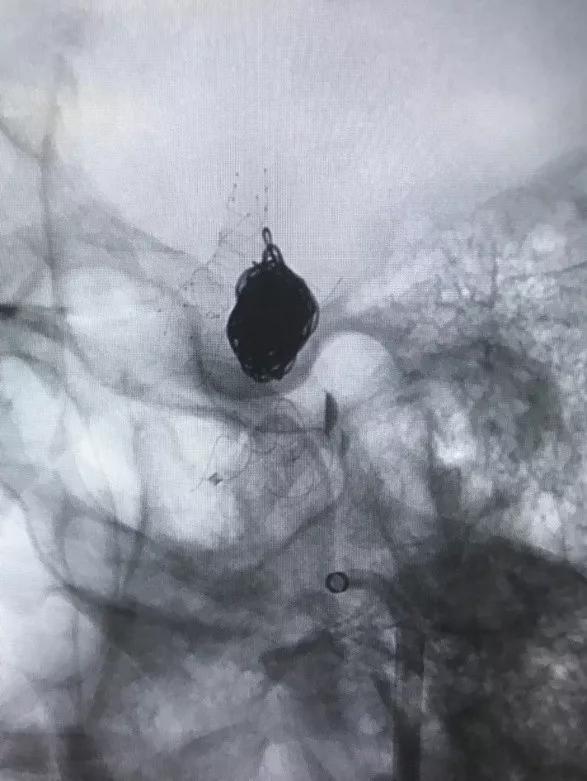 山东大学齐鲁医院王东海教授团队成功治疗多发性动脉瘤