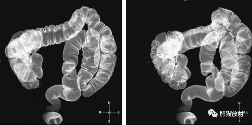 腹部影像图片大全,乙状直肠疼痛位置图片