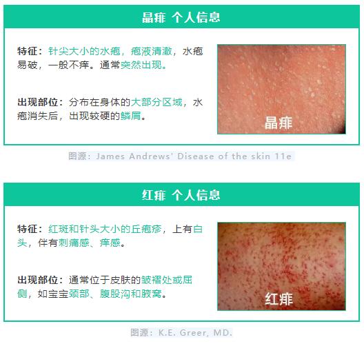 藿香正气水祛痱子快速消除,去痱子用风油精还是藿香正气液