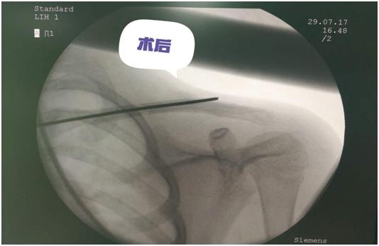 骨折一定要打石膏吗,骨折非要打钢钉吗