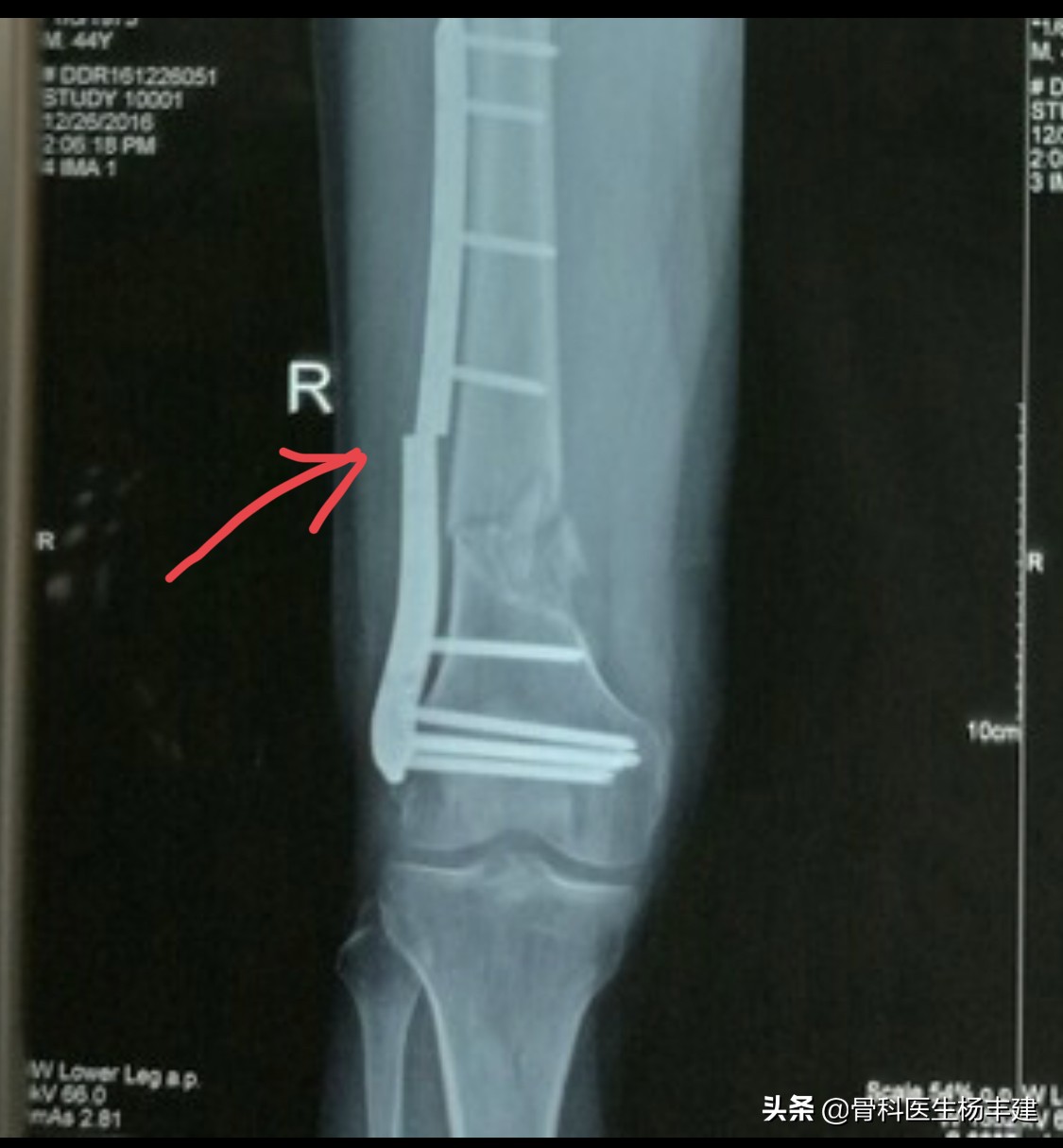 骨折手术后需要注意，什么情况下容易出现钢板断裂？