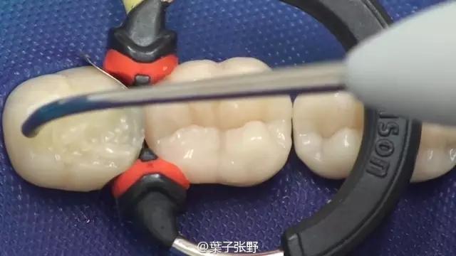 补牙疼吗补牙过程图,补牙全部过程是什么样子的