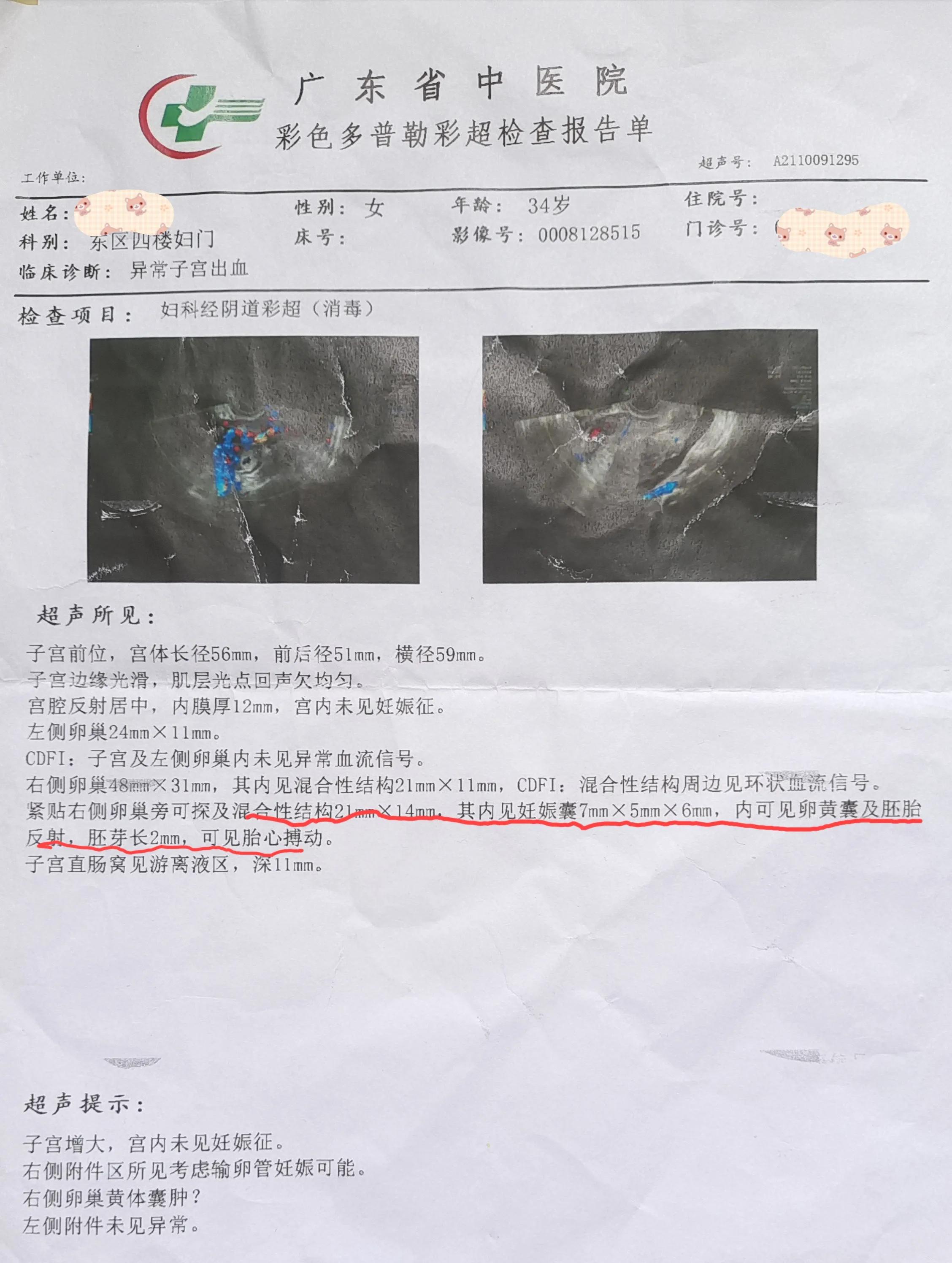 孕妈们不要忽视宫外孕,宫外孕大出血差点没命