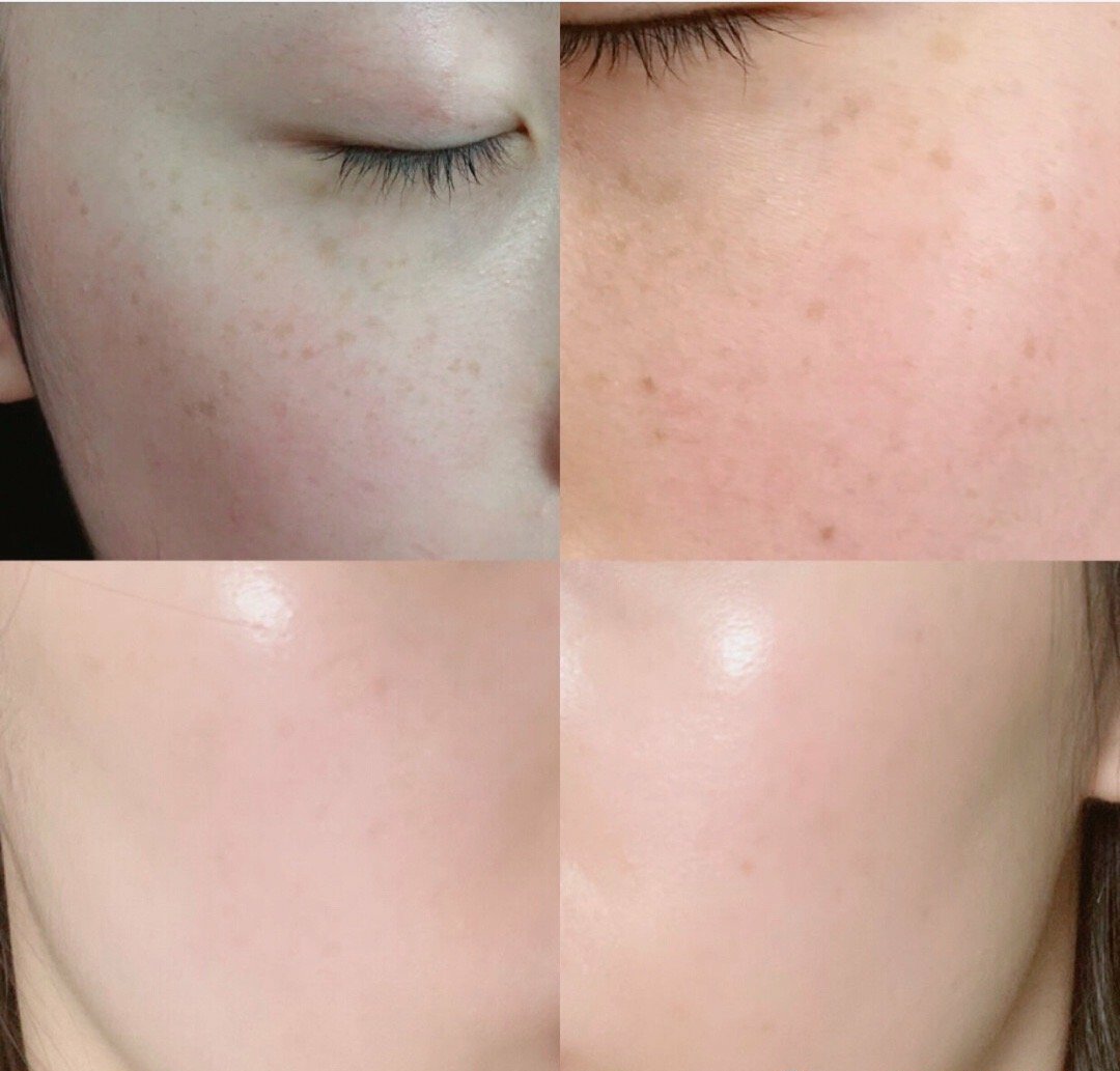 祛斑效果最好的祛斑方法,祛斑最有效的方法和技巧