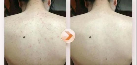 日本去螨虫皂,日本小黑皂号称螨虫克星