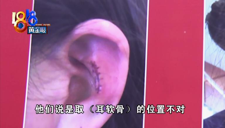 垫鼻尖取出耳软骨鼻子会萎缩吗,取耳软骨导致耳朵变贴了