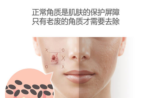 经常去角质变成敏感肌怎么办,怎么去除老化角质层