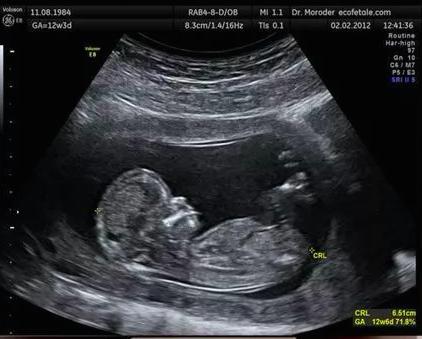 胎儿双顶径10厘米，为什么是顺产与否的一道坎儿？