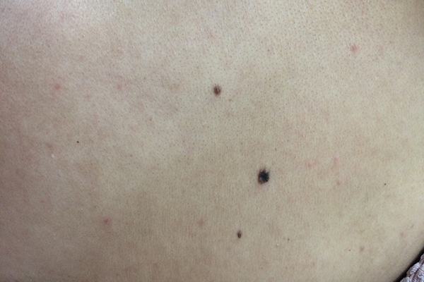 皮肤上出现黑痣是有癌风险,皮肤黑痣病是什么引起的