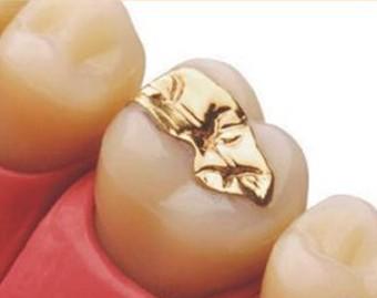 同样是补牙，为什么差距那么大？不同的补牙材料到底该怎么选？