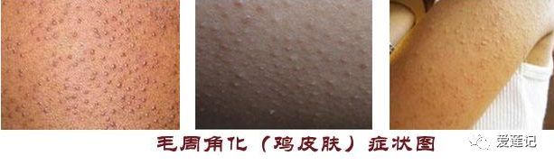 皮肤上有小红点挂什么科,皮肤上小红点变成小黑点