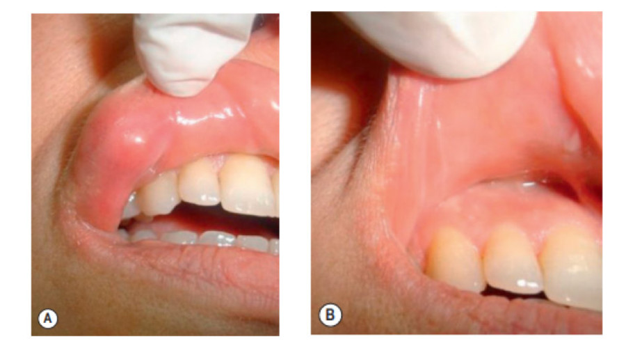 玻尿酸注射下巴的过程视频,注射玻尿酸能维持多长时间