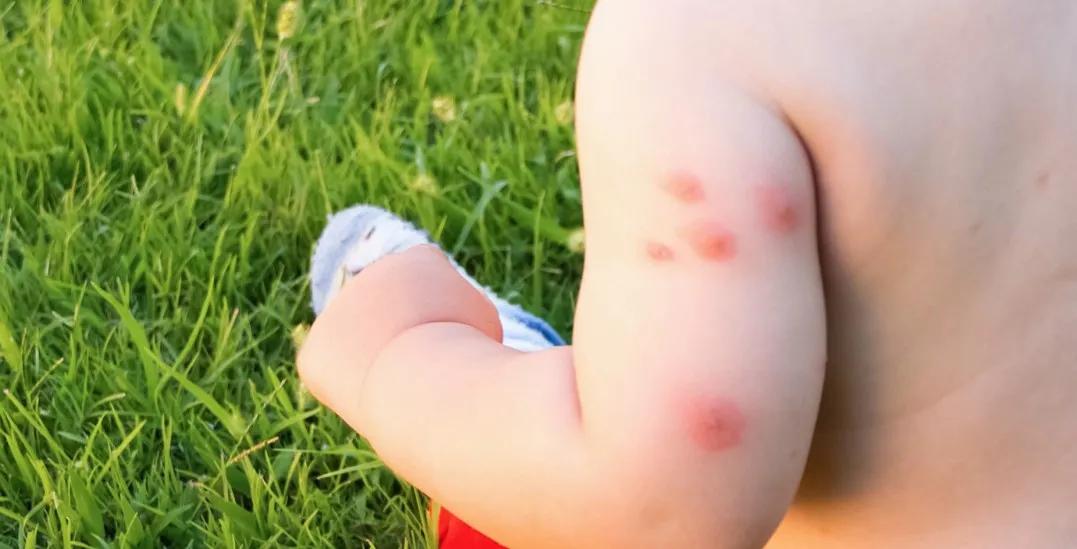 脸上皮肤过敏可以用炉甘石洗剂吗,皮肤有渗液用了炉甘石洗剂会怎样