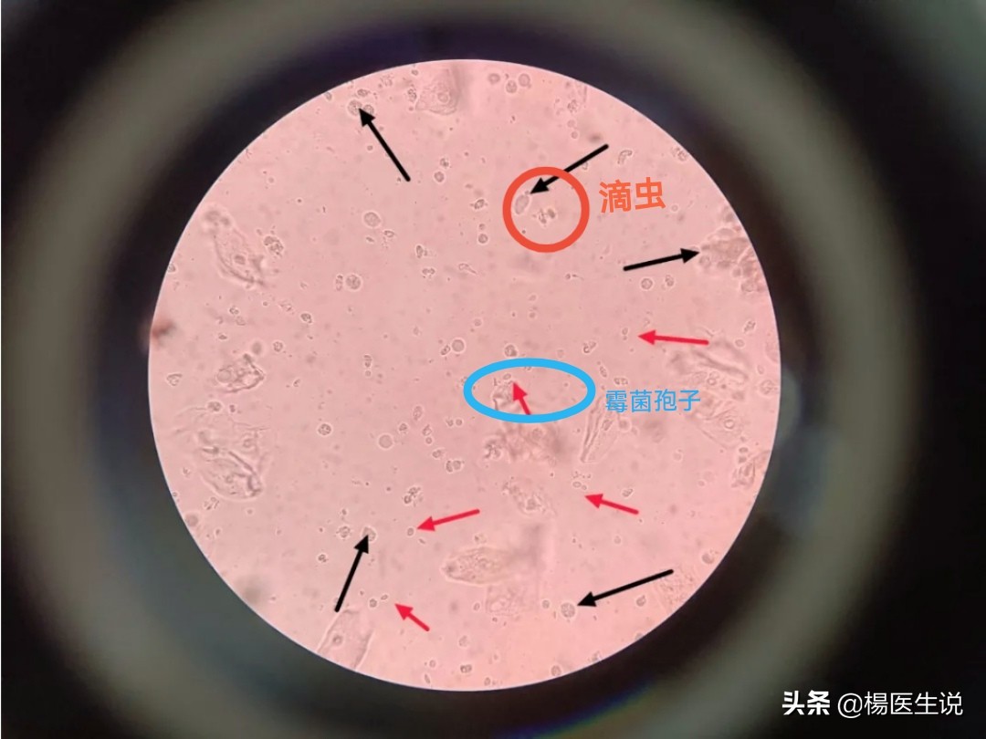滴虫性阴道炎和霉菌性症状区别,滴虫性阴道炎和霉菌性症状表现