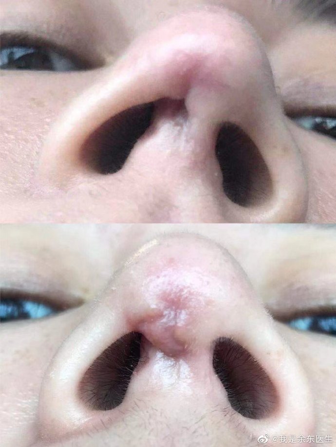 修复隆鼻失败手术,隆鼻后失败