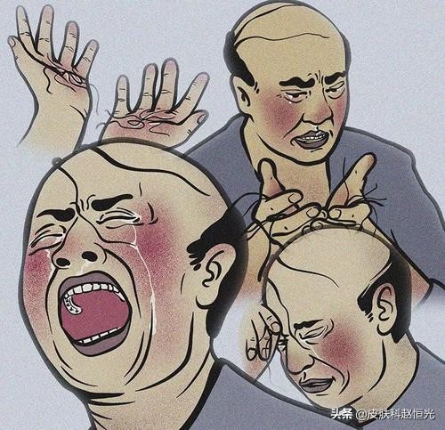 脱发严重可以用米诺地尔吗,米诺地尔液治疗脱发可以停用吗