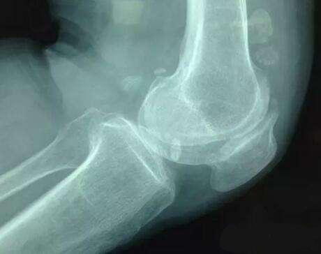 治疗骨关节炎消炎止痛的膏药,骨关节炎症怎么办才能彻底消除