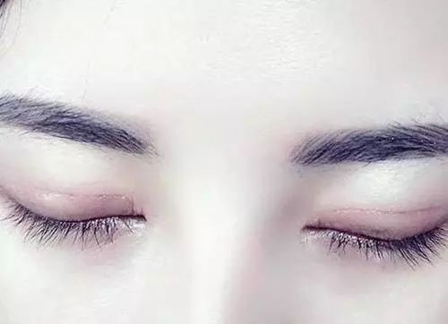 割完双眼皮不忌嘴会怎样,全切双眼皮疤痕增生期是什么时候