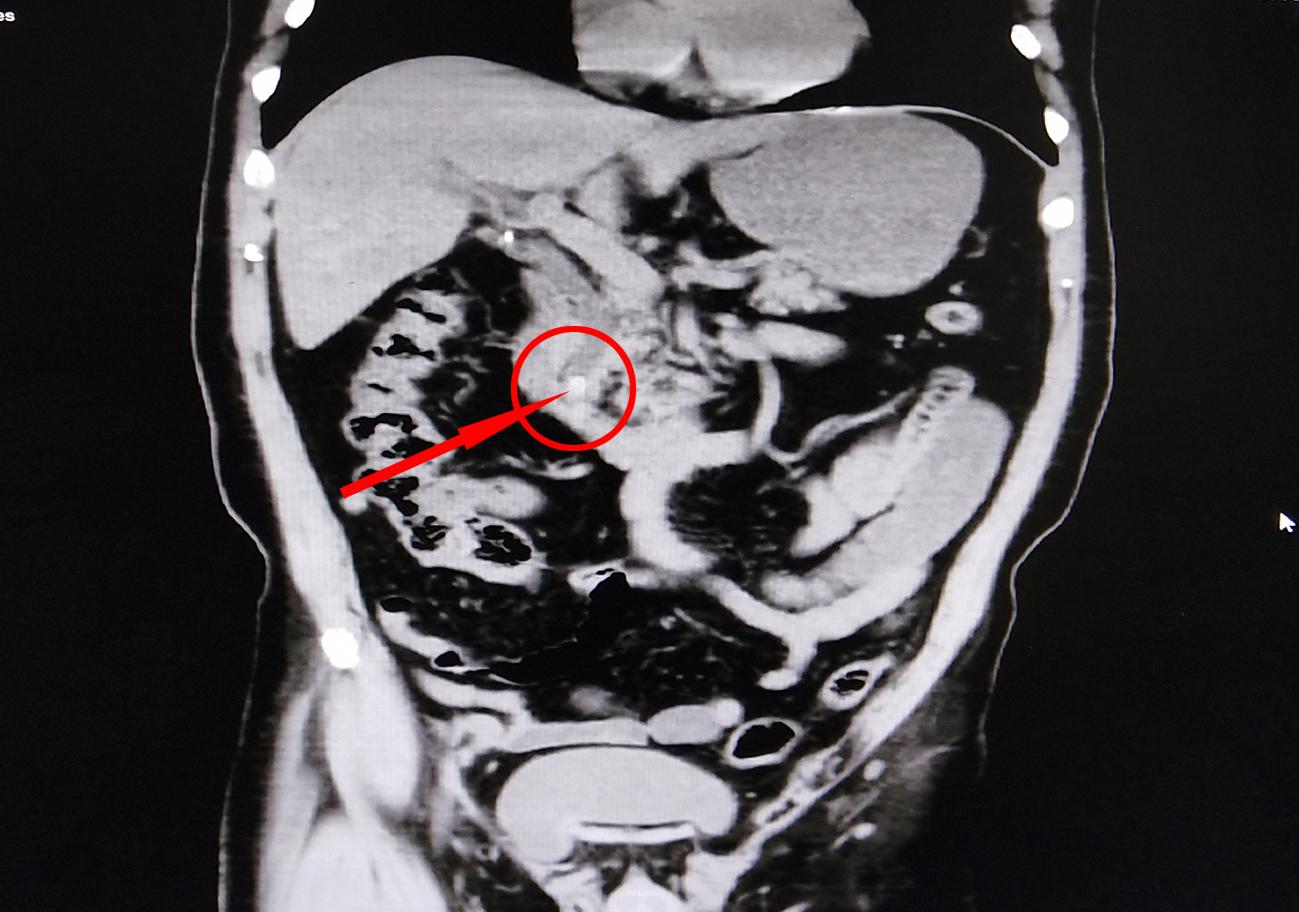无创取胆结石,无创胆结石手术