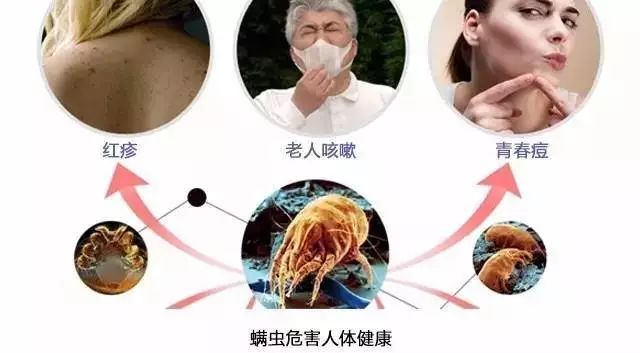 身上长痘、哮喘鼻炎可能都是螨虫惹的祸!除螨用这招,螨虫死光光
