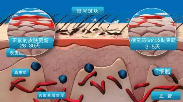 专治牛皮癣银屑病的外用药膏,治疗牛皮癣银屑病民间土方17种