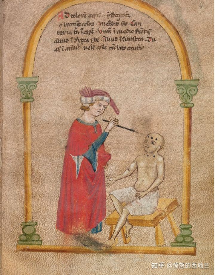 微创手术对偏头痛的治疗