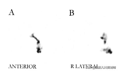 孩子洗鼻子用什么药水,洗鼻子正确方式