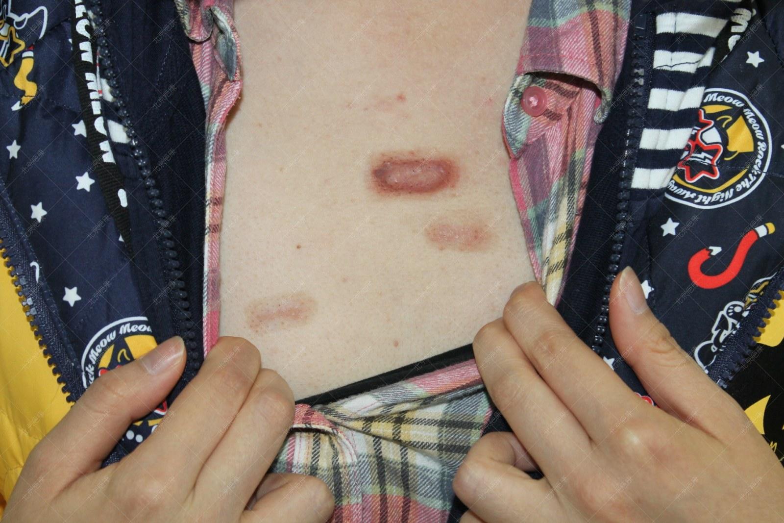 疤康医院治疗疤痕大概多少钱,祛疤灵能去除疤痕吗