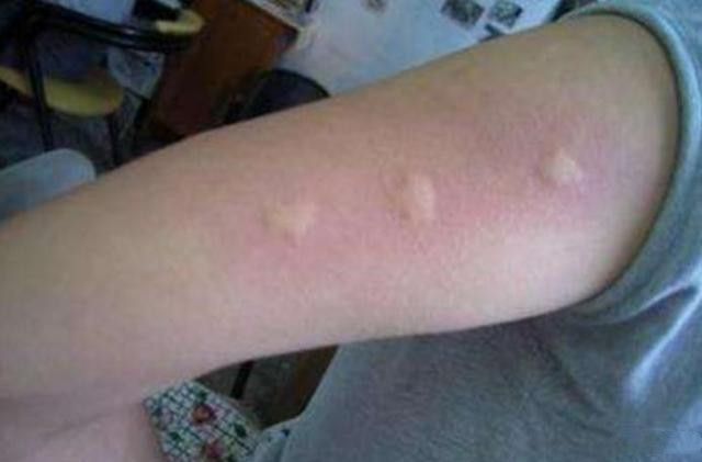 孩子容易被蚊子咬怎样防蚊有效,宝宝总被蚊子叮怎么预防