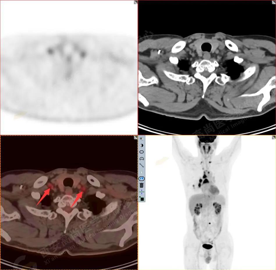 petct检查报告肺结节考虑恶性肿瘤,30mm肺结节pet显示没有转移