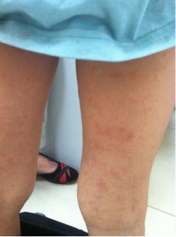 熬夜追剧身上起红点,连续熬夜后身上起红点