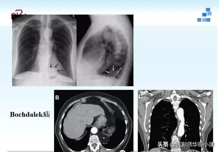 「精品课件」胸部膈肌的解剖及常见病变影像的表现