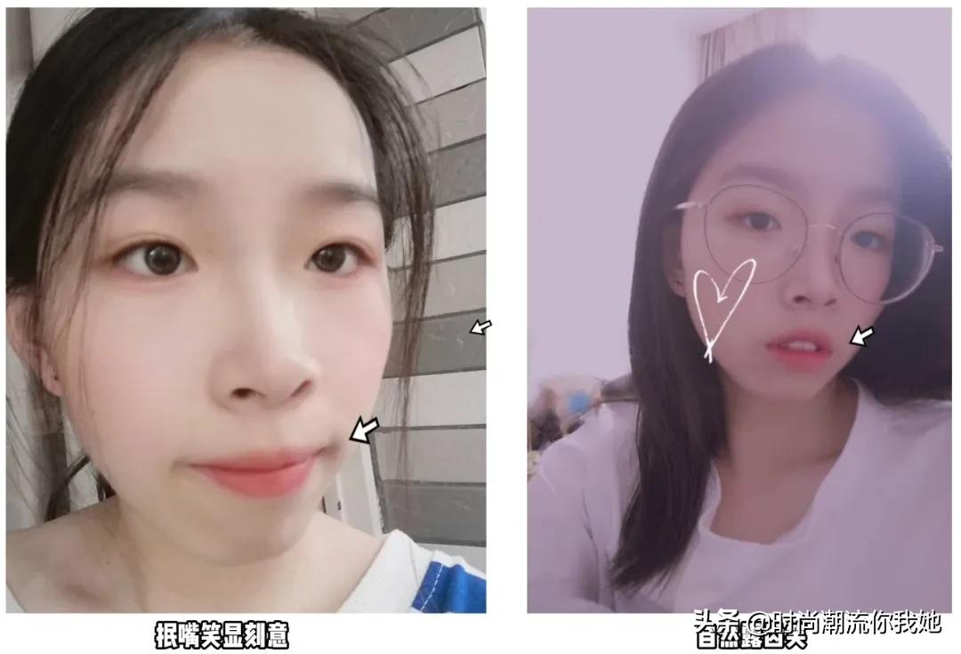 单眼皮凸嘴素人改造,肿眼泡整容成功案例