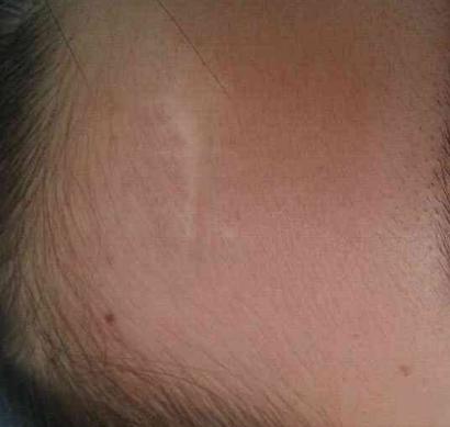 小孩被查出疑似白癜风,8岁孩子被确诊白癜风