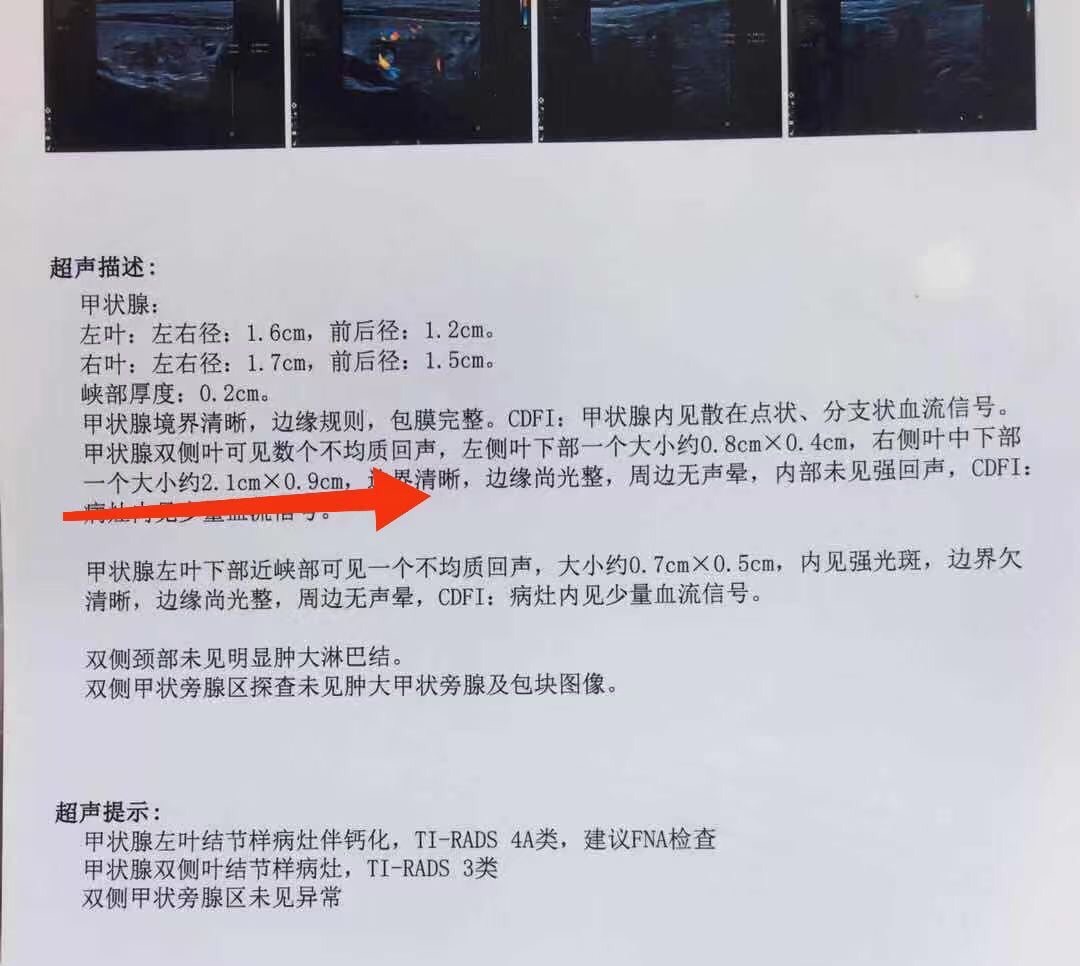 十几岁的小女孩有喉结了怎么办,从小就有喉结会是甲状腺吗