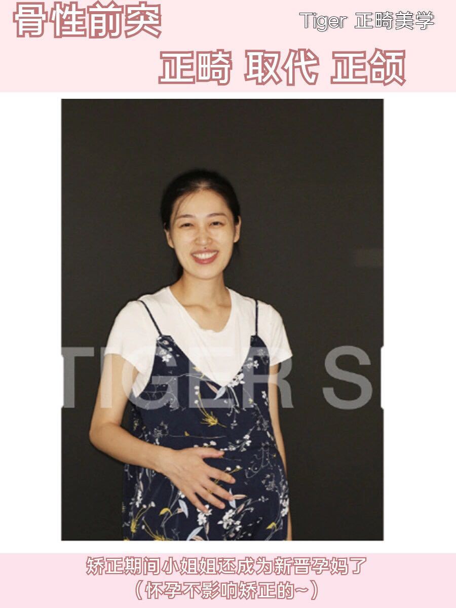 南京成人隐形牙齿矫正一般多少钱,隐适美牙齿矫正比较好的医院