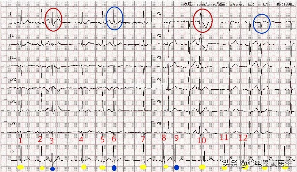 频发室性早搏部分为室性融合波,室性早搏与差异性传导鉴别