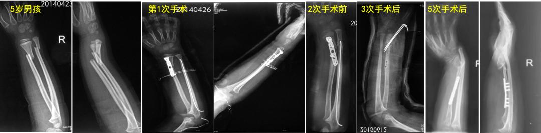 两个儿童前臂骨折争议病例之——元芳你怎么看
