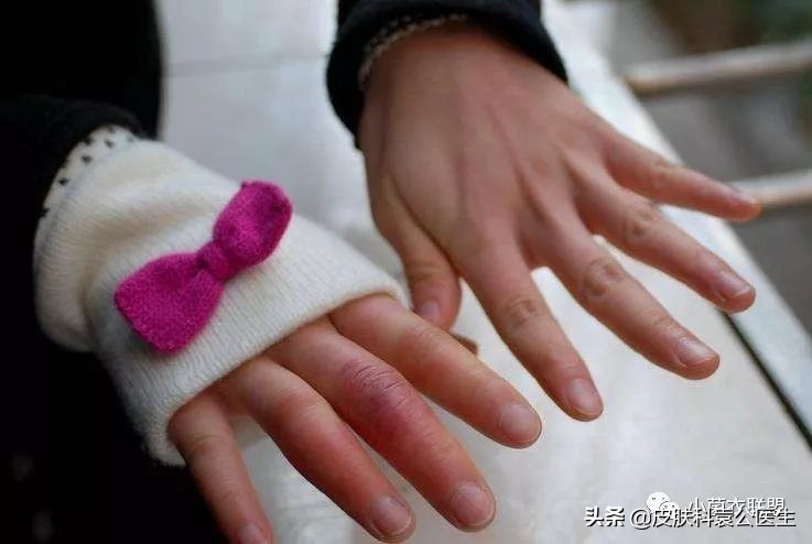 冻伤后痒痒是怎么回事,冻疮后期接触水干燥发痒怎么治