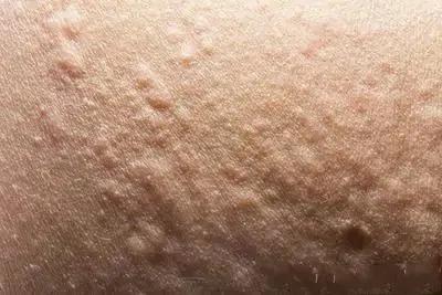 慢性荨麻疹吃什么药,慢性荨麻疹要吃中药调理吗