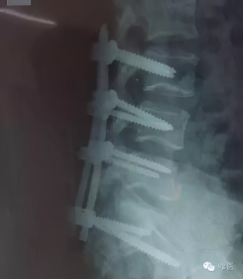 腰椎压缩性骨折保守治疗畸形愈合,骨折或关节脱位的急救处理