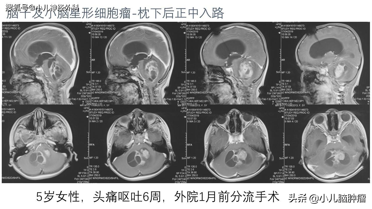 颅内肿瘤引起脑积水，是不是都要做分流手术
